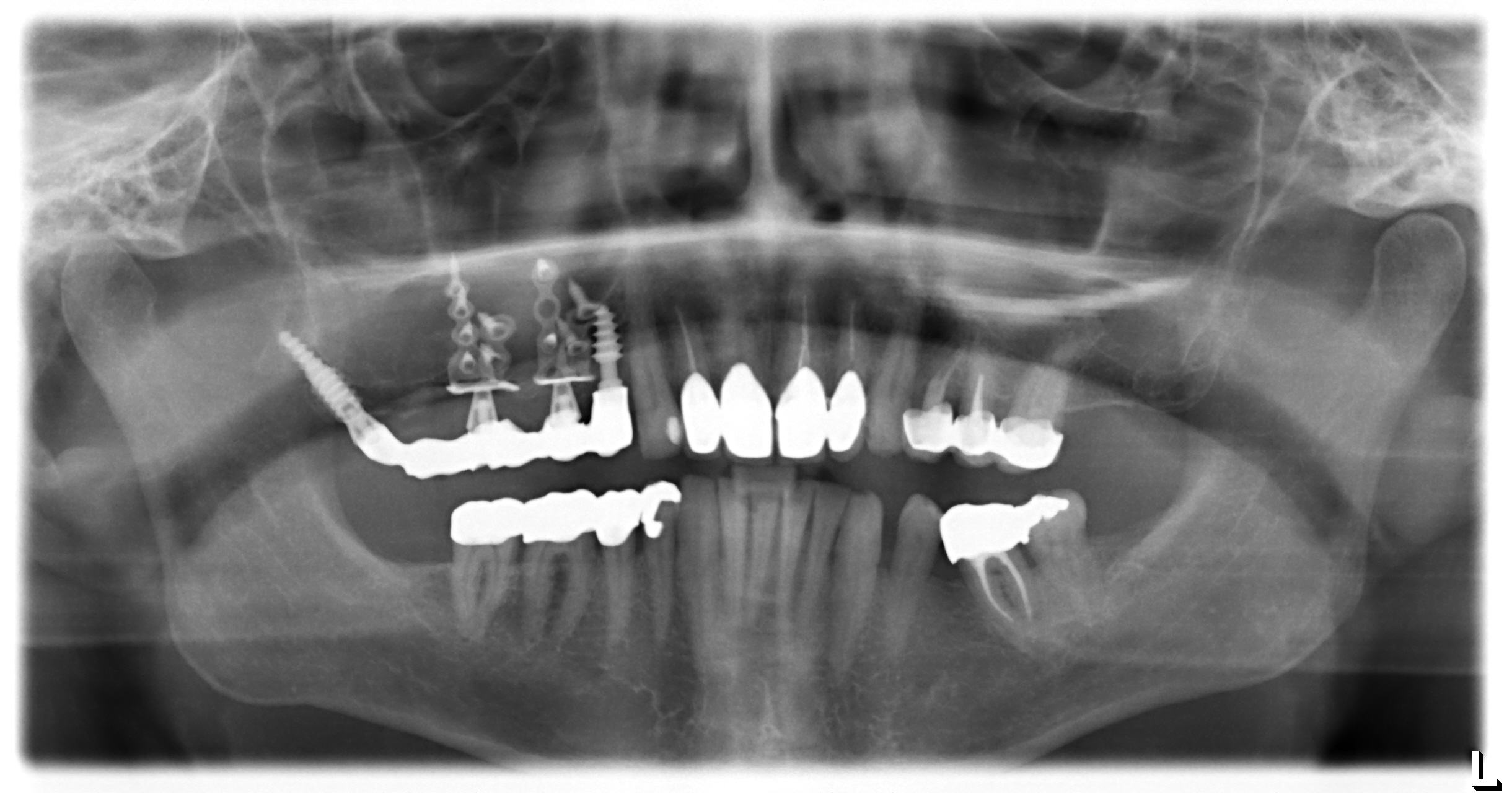 Treatment option in the atrophied maxilla without bonegraft and without ...